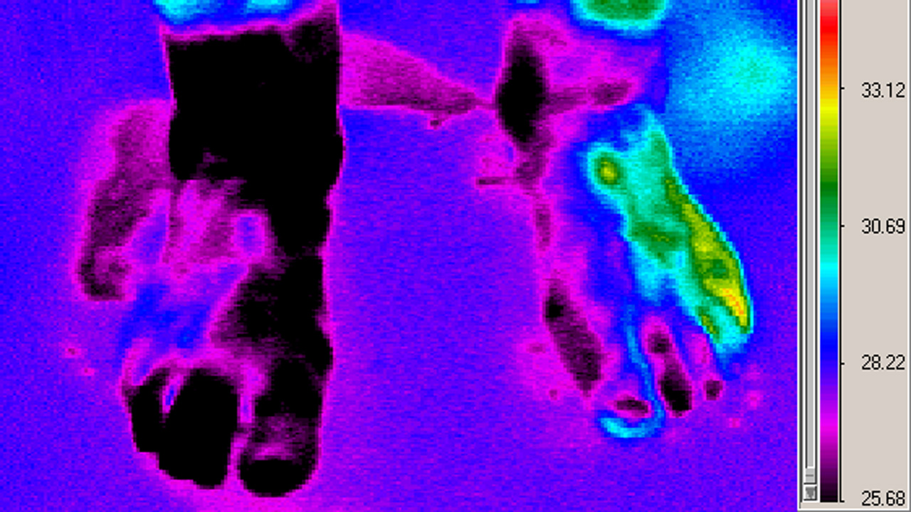 Medical IR thermography